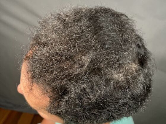 FUE Hair Restoration: Case 13 - After