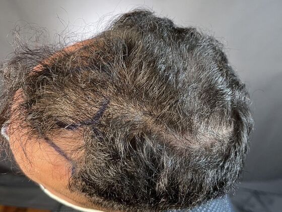 FUE Hair Restoration: Case 13 - Before