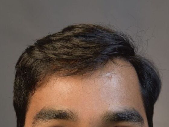 FUE Hair Restoration: Case 14 - After