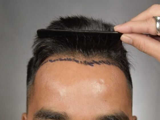 FUE Hair Restoration: Case 14 - Before