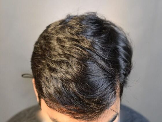 FUE Hair Restoration: Case 14 - After