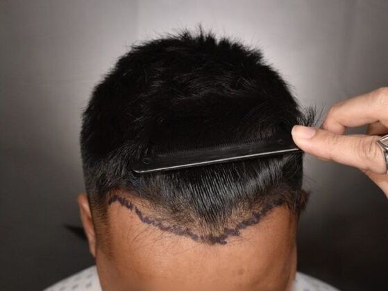 FUE Hair Restoration: Case 14 - Before