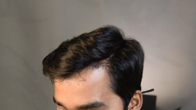 FUE Hair Restoration: Case 14 - After