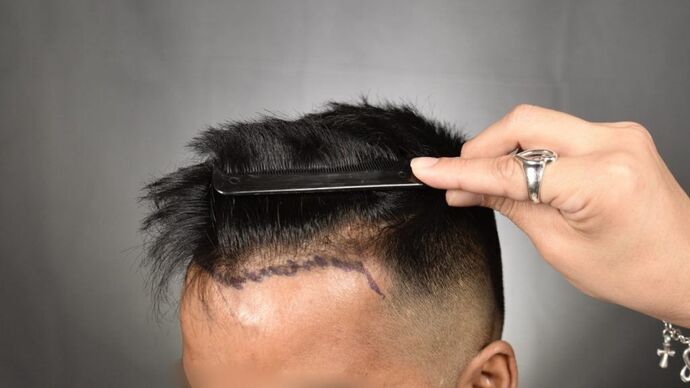 FUE Hair Restoration: Case 14 - Before