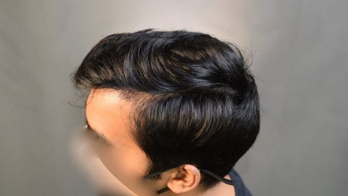 FUE Hair Restoration: Case 14 - After