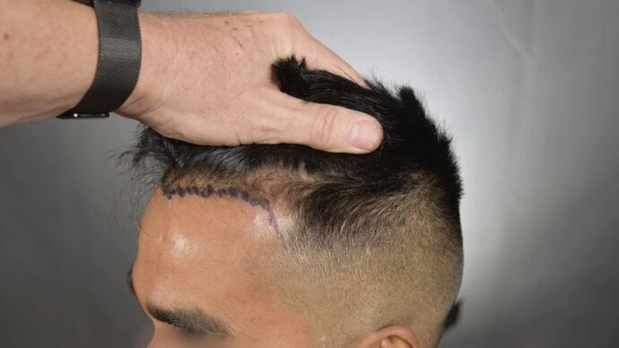 FUE Hair Restoration: Case 14 - Before