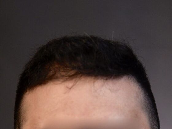 FUE Hair Restoration: Case 15 - After