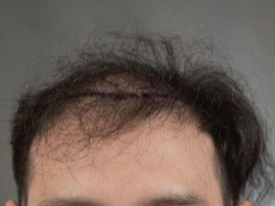 FUE Hair Restoration: Case 15 - Before