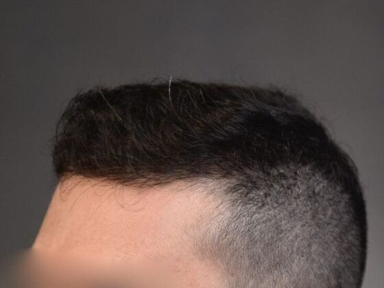 FUE Hair Restoration: Case 15 - After