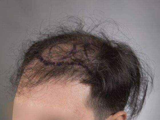 FUE Hair Restoration: Case 15 - Before