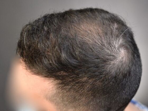 FUE Hair Restoration: Case 15 - After