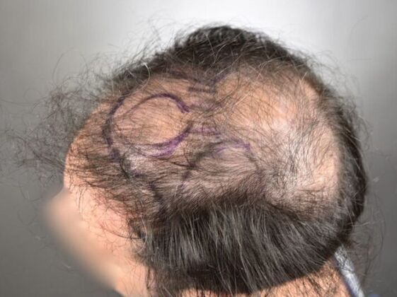 FUE Hair Restoration: Case 15 - Before