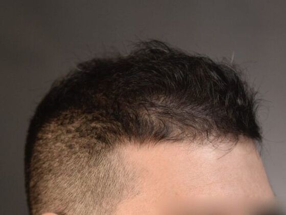 FUE Hair Restoration: Case 15 - After