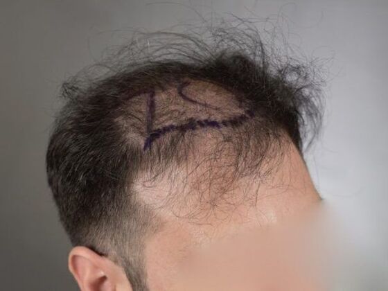 FUE Hair Restoration: Case 15 - Before