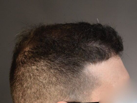 FUE Hair Restoration: Case 15 - After