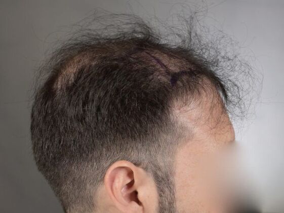 FUE Hair Restoration: Case 15 - Before