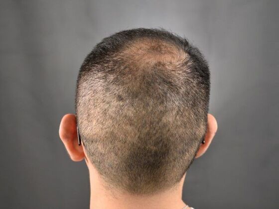 FUE Hair Restoration: Case 17 - After