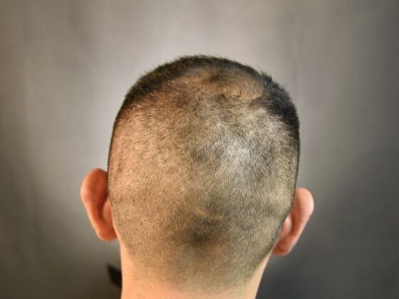 FUE Hair Restoration: Case 17 - Before