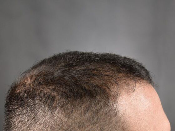 FUE Hair Restoration: Case 17 - After