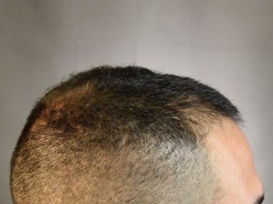 FUE Hair Restoration: Case 17 - Before