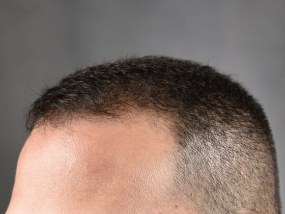 FUE Hair Restoration: Case 17 - After