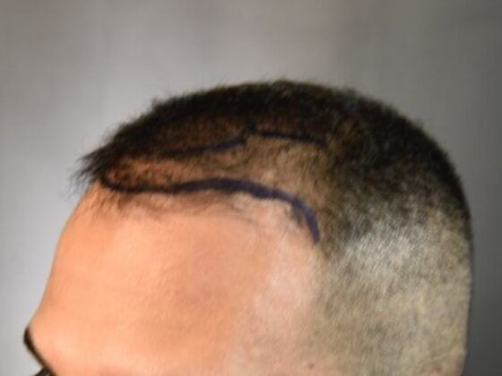 FUE Hair Restoration: Case 17 - Before