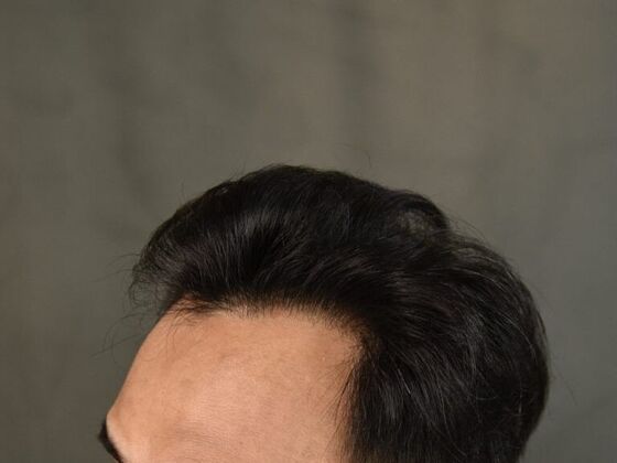 FUE Hair Restoration: Case 18 - After