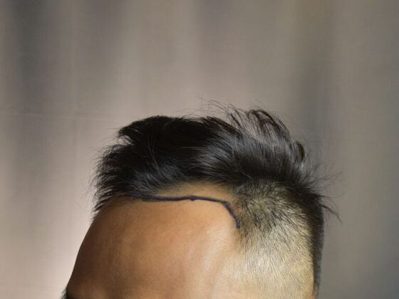 FUE Hair Restoration: Case 18 - Before