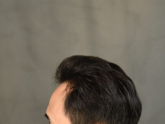 FUE Hair Restoration: Case 18 - After