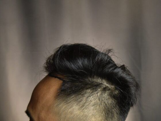 FUE Hair Restoration: Case 18 - Before