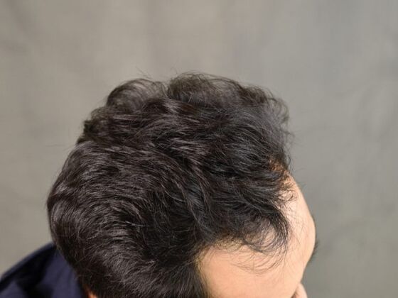 FUE Hair Restoration: Case 18 - After
