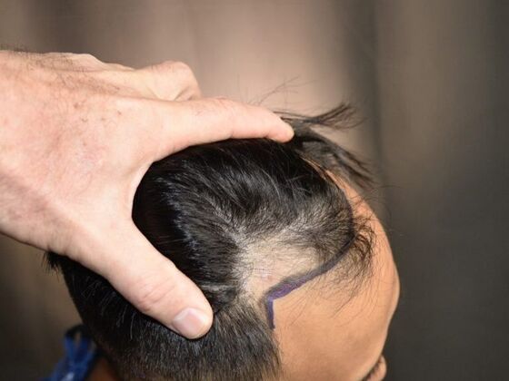 FUE Hair Restoration: Case 18 - Before