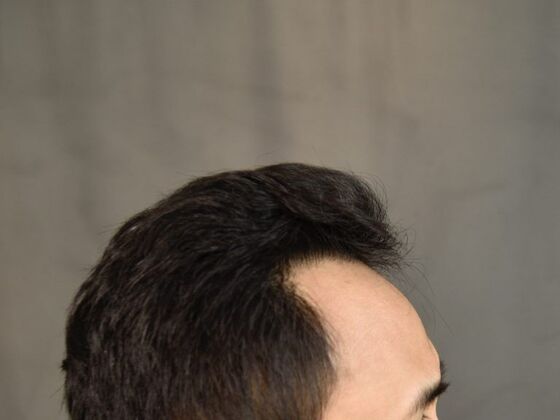 FUE Hair Restoration: Case 18 - After