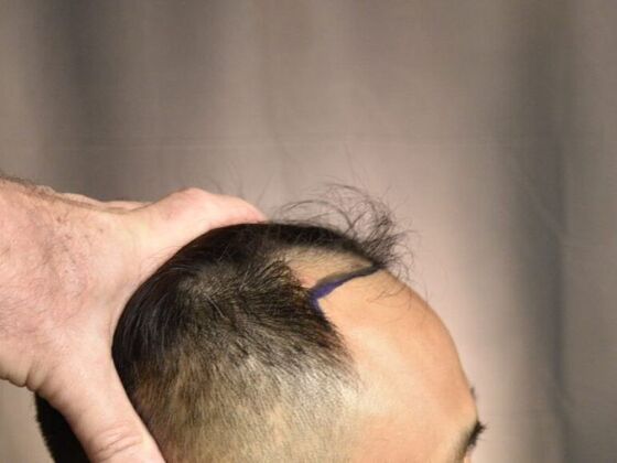 FUE Hair Restoration: Case 18 - Before