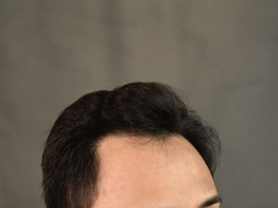 FUE Hair Restoration: Case 18 - After