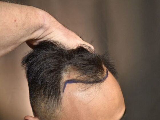 FUE Hair Restoration: Case 18 - Before