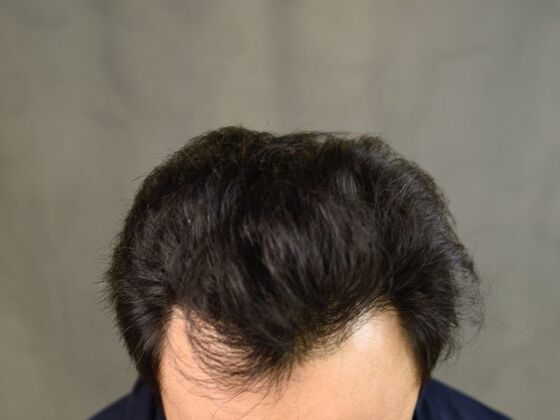 FUE Hair Restoration: Case 18 - After