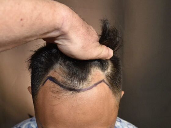 FUE Hair Restoration: Case 18 - Before