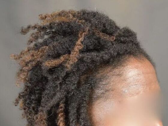 FUT Female Case 2 - After