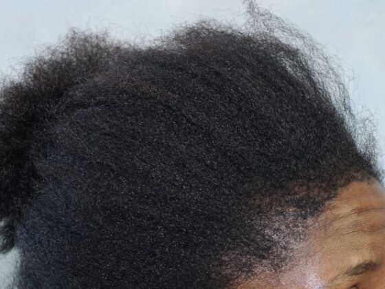 FUT Female Case 2 - Before