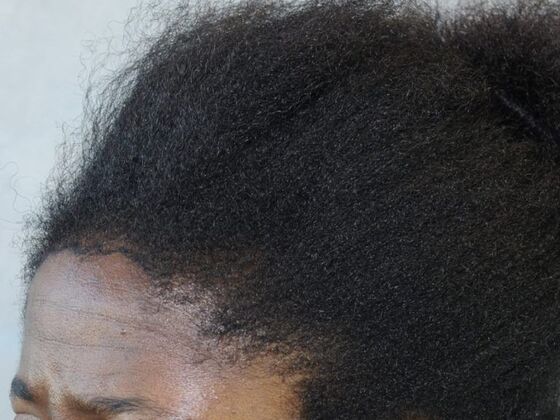 FUT Female: Case 2 - Before