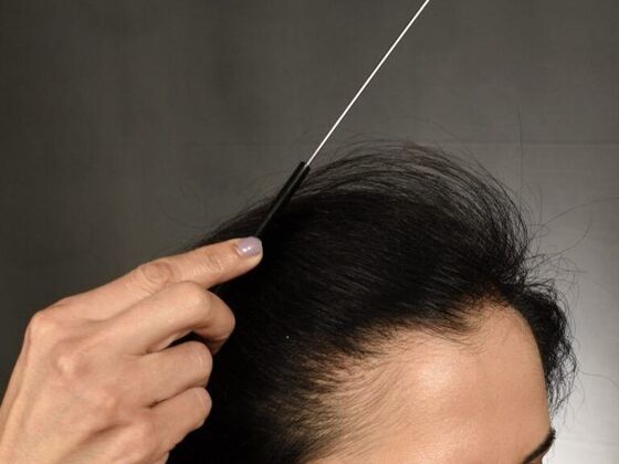 FUT Female Case 3 - After