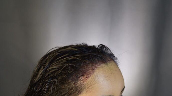 FUT Female: Case 3 - After