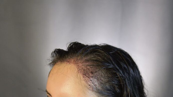 FUT Female: Case 3 - After