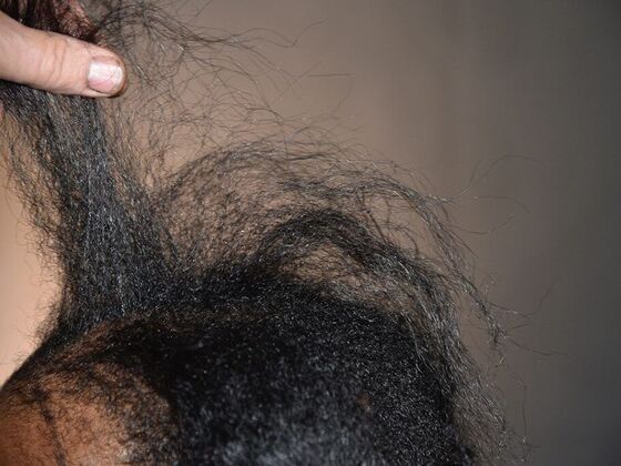 FUT Female: Case 4 - Before