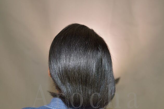 FUT Female: Case 4 - After