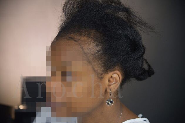 FUT Female: Case 4 - Before