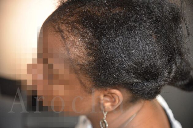 FUT Female: Case 4 - Before