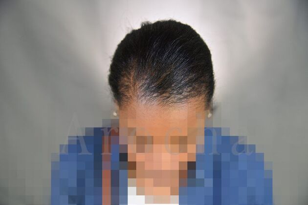 FUT Female: Case 4 - After