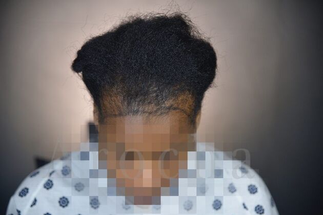 FUT Female: Case 4 - Before